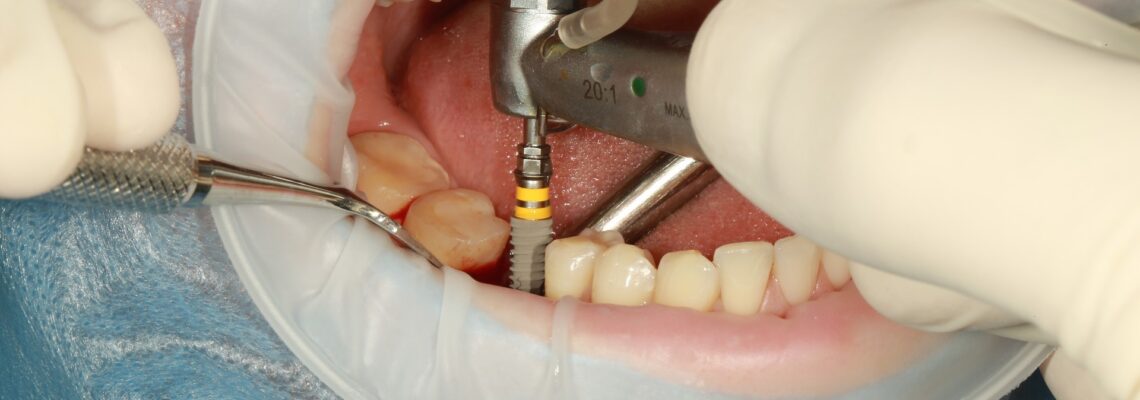 implants dentaires